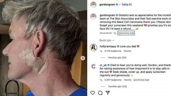 Gordon Ramsay Güneşe Dair Uyarı: Güneş Kremi Kullanımı İçin Çağrısı ve Cilt Sağlığı